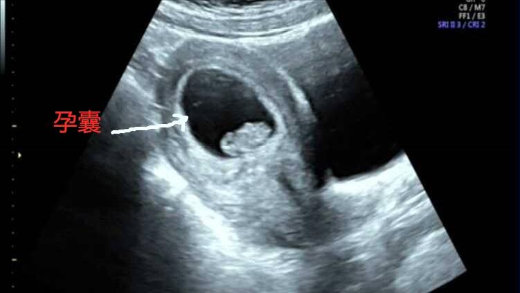 药流伤害大还是紧急避孕药伤害大,药流安全还是手术流产安全