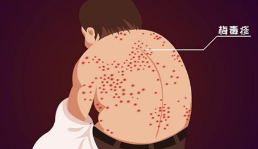 得了梅毒会有什么症状,得了梅毒会有哪些症状