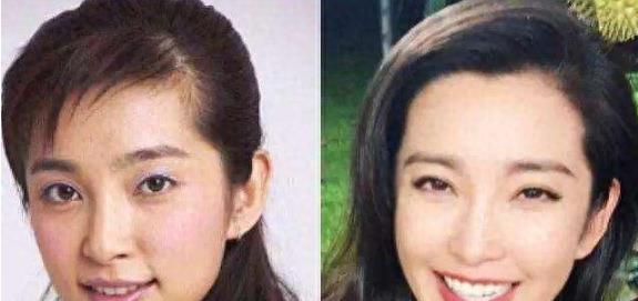 明星烤瓷牙发黑,明星烤瓷牙牙齿磨小后照片