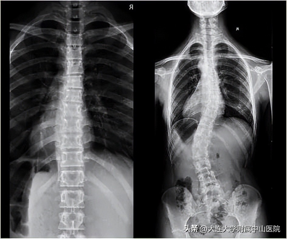 脊柱侧弯康复训练直播回放,脊柱侧弯体态矫正封闭训练营