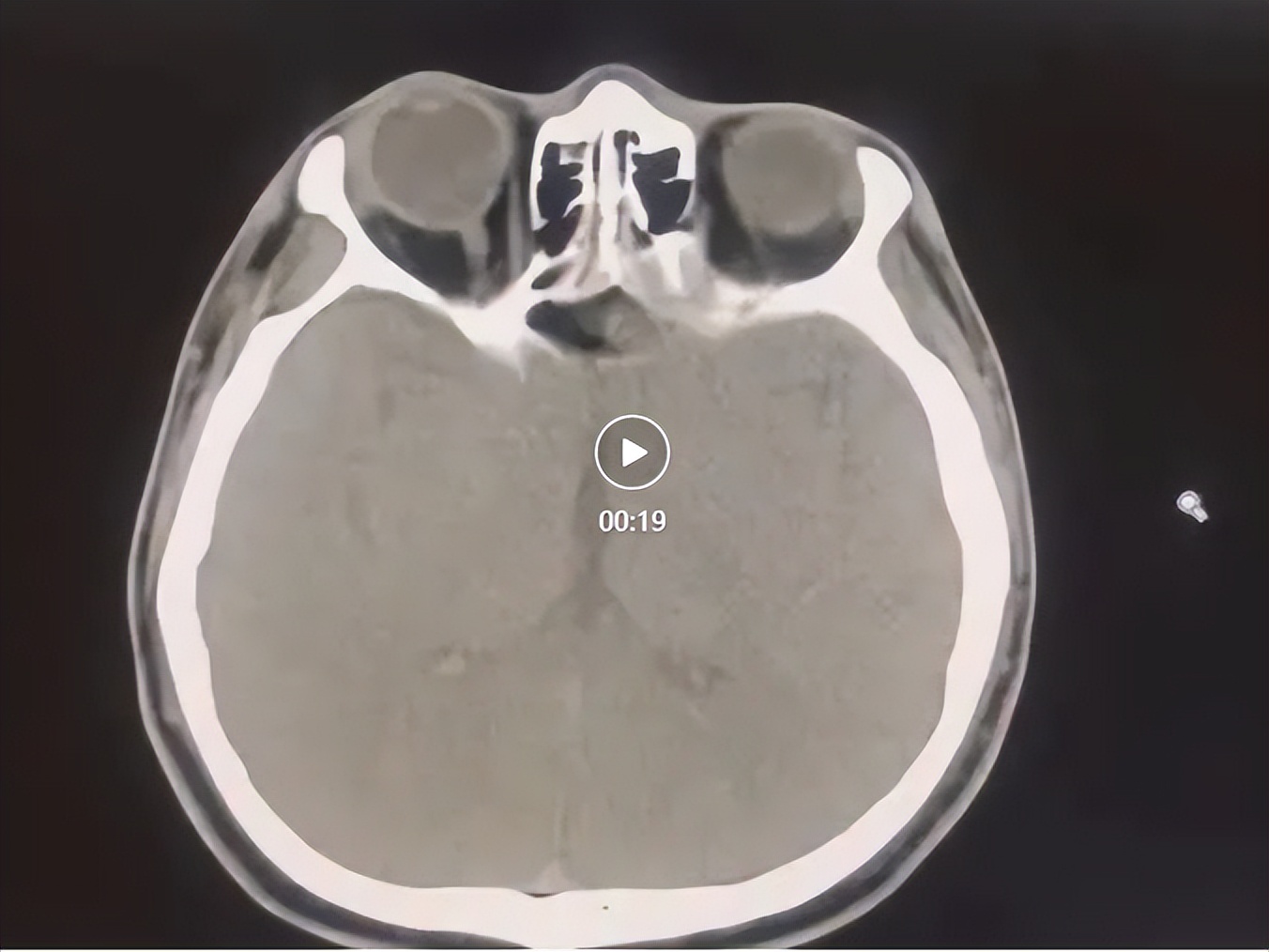 上海耳鼻喉科医院门诊手术,上海耳鼻喉科医院置管手术