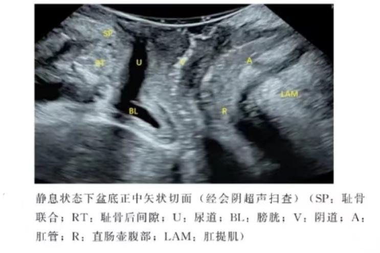 关爱女性盆底健康从盆底超声开始