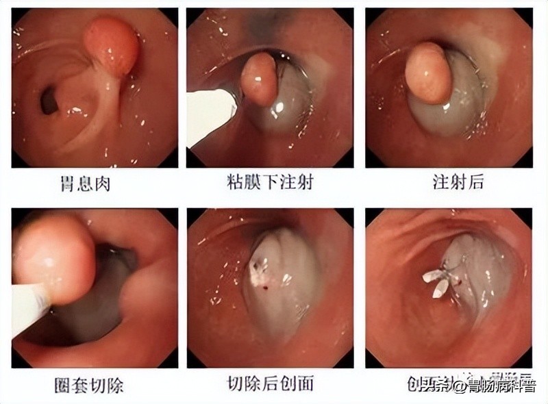 胃息肉切除多久能正常吃饭,胃息肉切除伤口多久能愈合