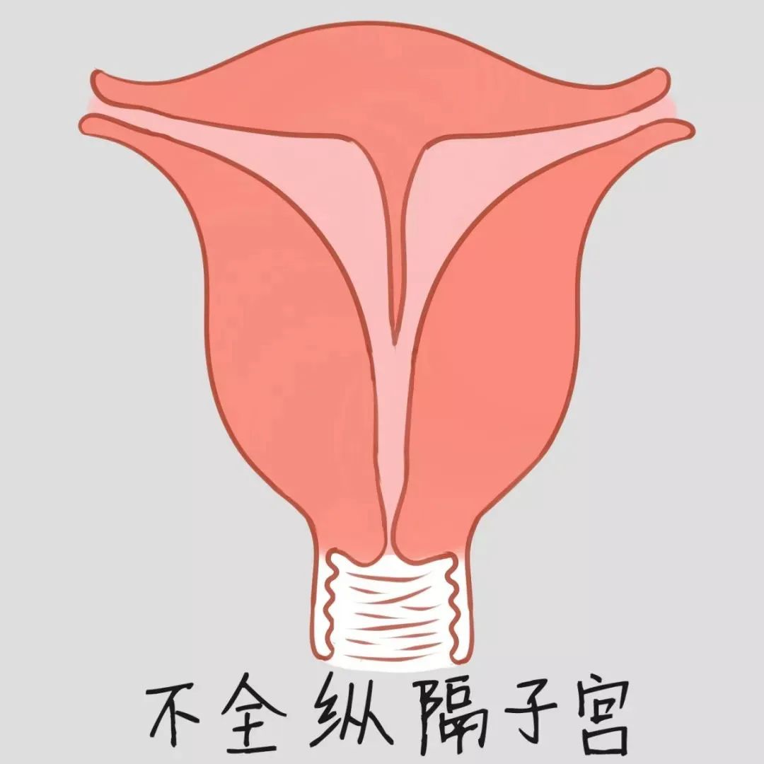 医生，B超提示我有子宫畸形，怎么办？