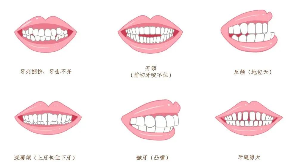 做牙齿矫正前你应该了解哪些,牙齿矫正前要洗牙吗