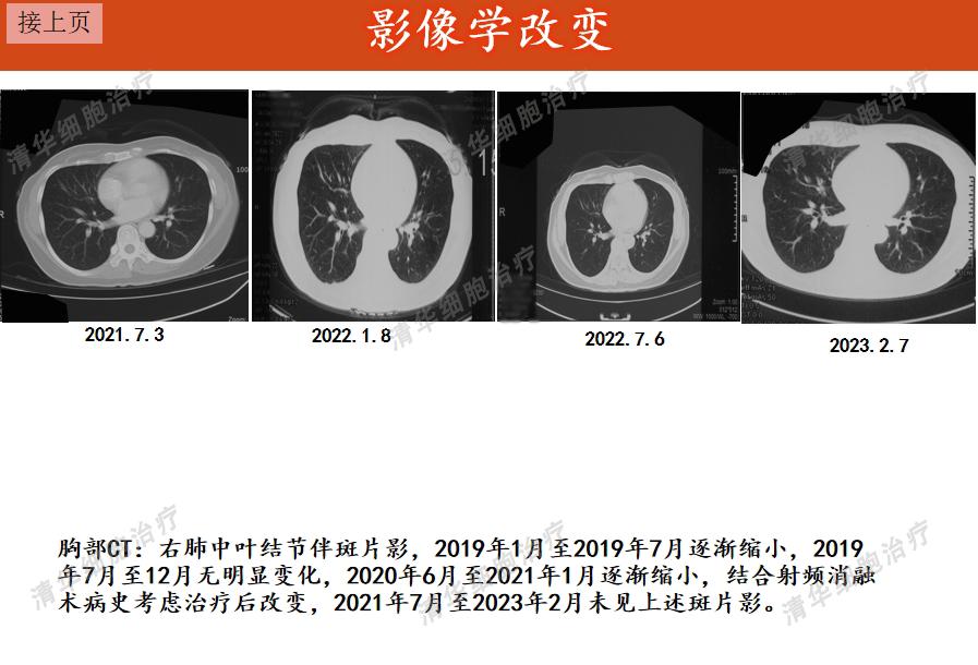 肉瘤领域的免疫疗法新策略,肉瘤免疫治疗的费用