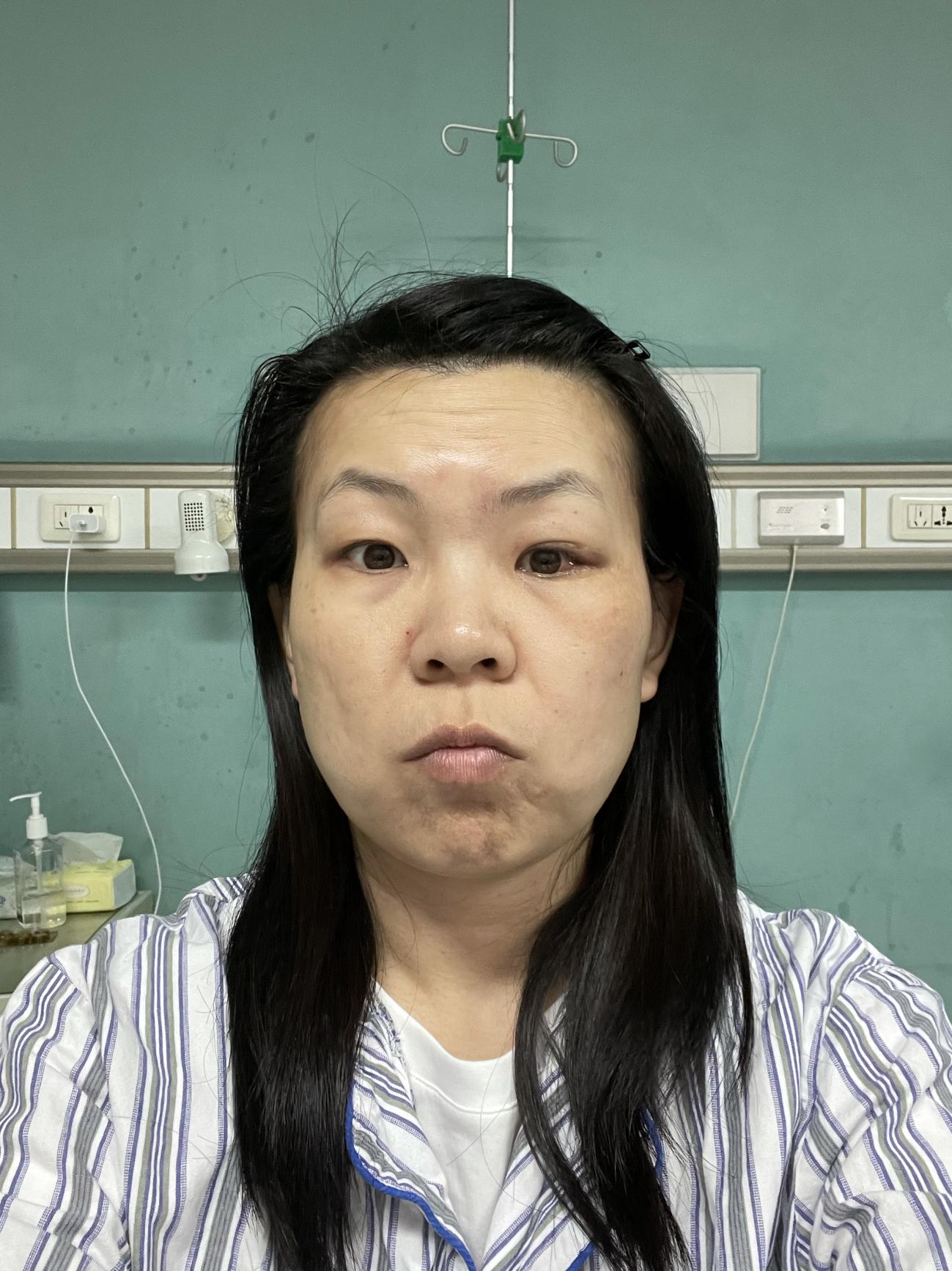 终于找到正确的医生治疗我的眼眶蜂窝织炎：详细记录住院康复经历