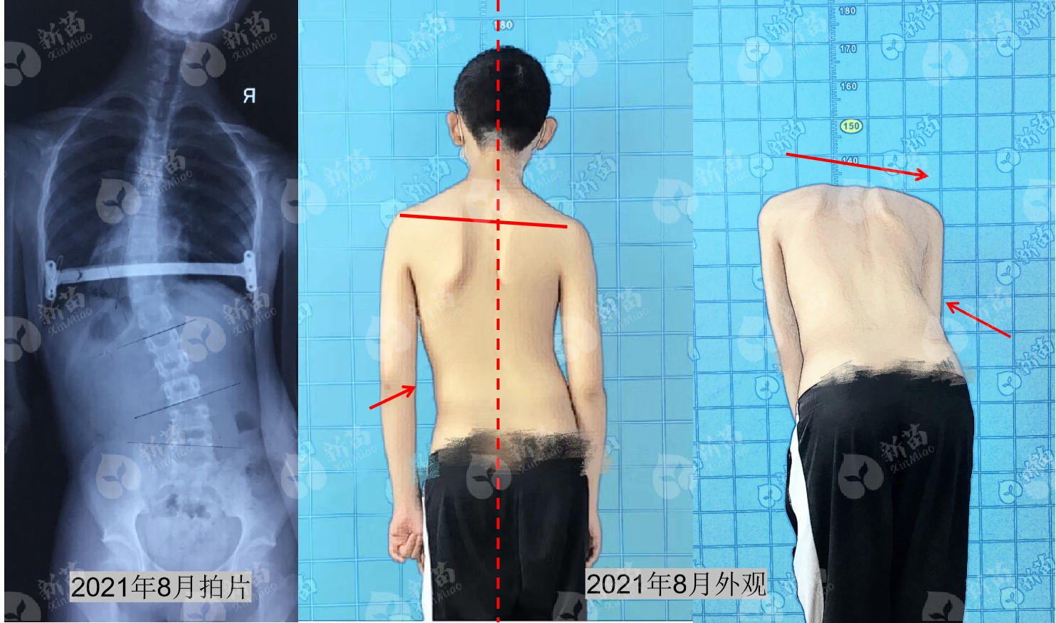 青少年脊柱侧弯如何自我矫正,青少年脊柱侧弯自我矫正