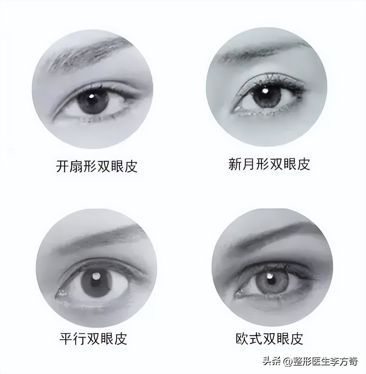 整形医院说双眼皮有几种技术,整形医生如何进行手术
