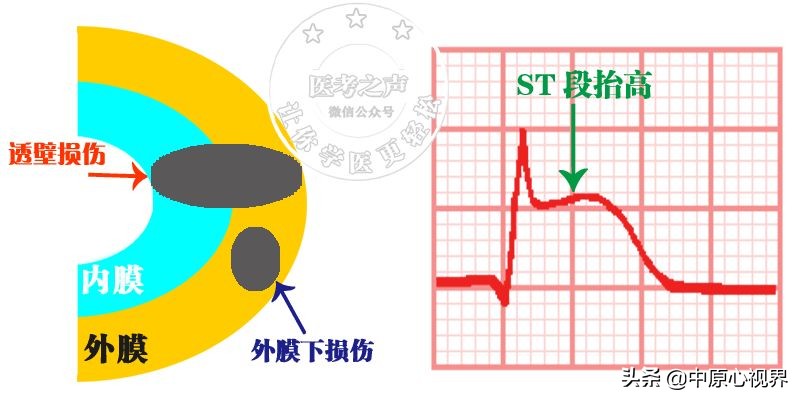 护考几种常见的心电图,常见的心电图图形分析