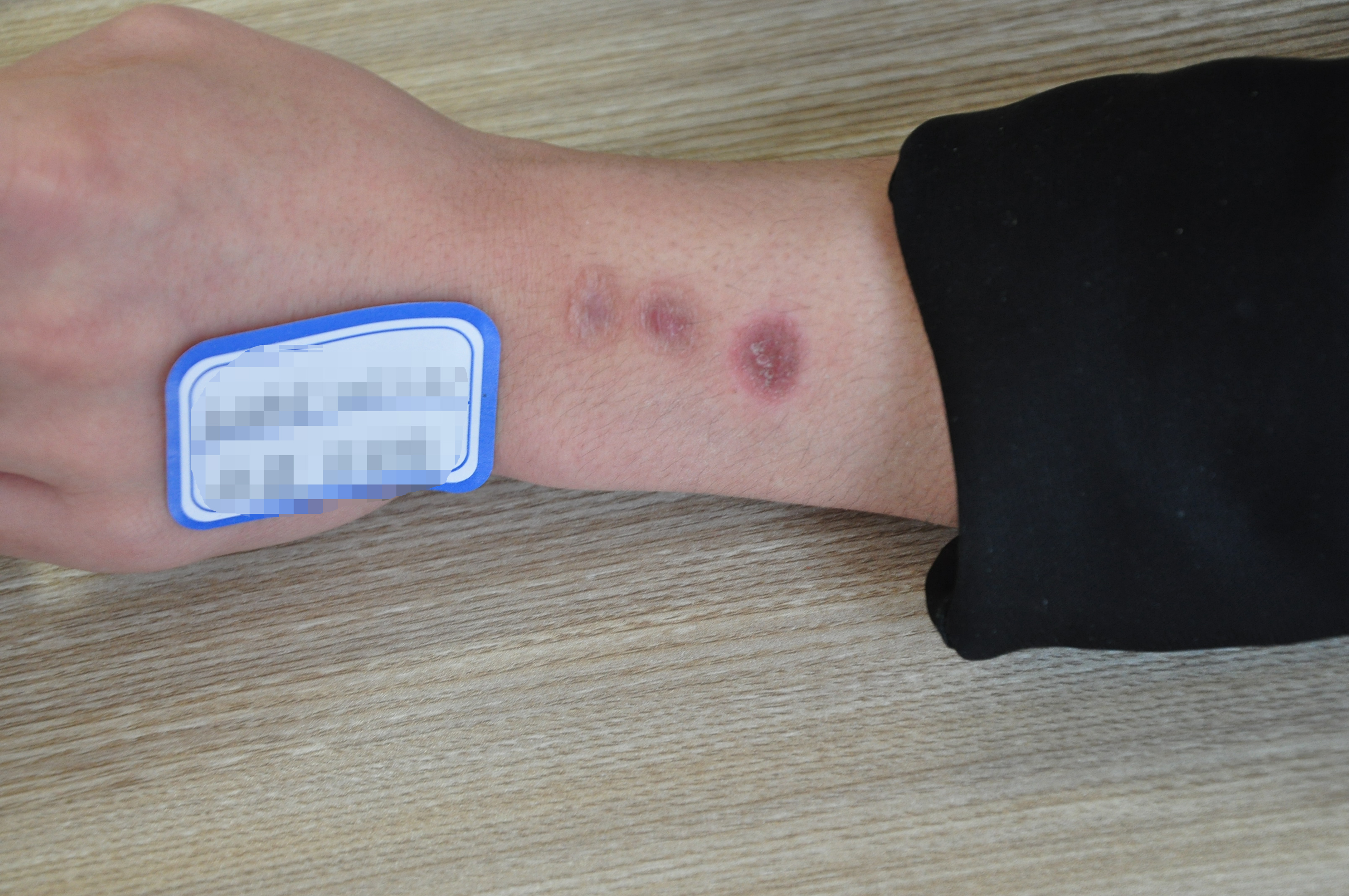 烟疤凸起疤痕怎么去除,河南疤痕增生去除方法