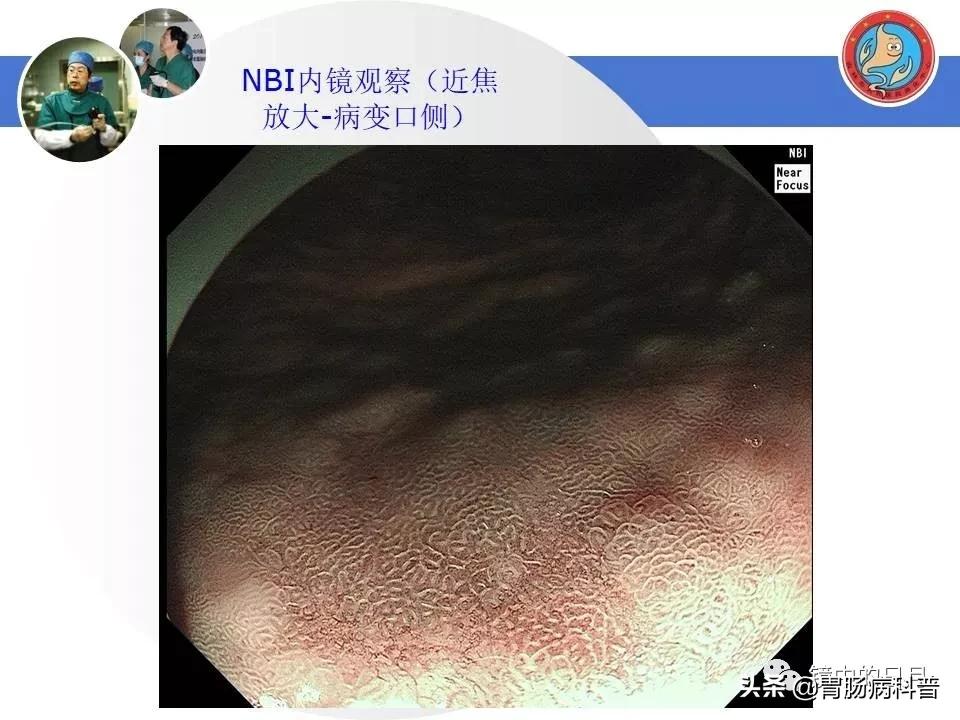 胃癌可以做内镜手术吗,早期胃癌内镜手术后追加外科手术