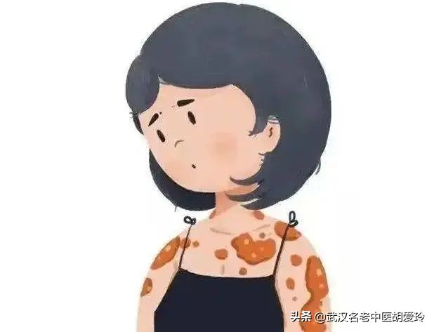 手上长了一块圆形的癣却不怎么痒,身上起了圆形干皮癣怎么回事