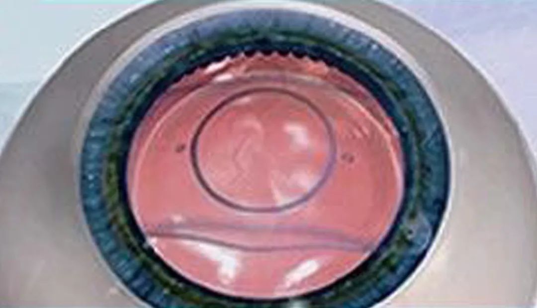 史上超全近视手术全攻略摘镜必看,近视手术怎么做收好这份免费攻略