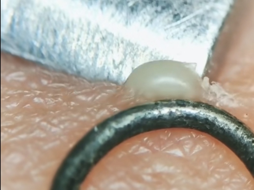 背后长痘不用药怎么办,后背长痘不留痘印