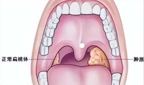 儿童急性扁桃体炎症状及治疗,急性扁桃体炎的主要并发症是什么