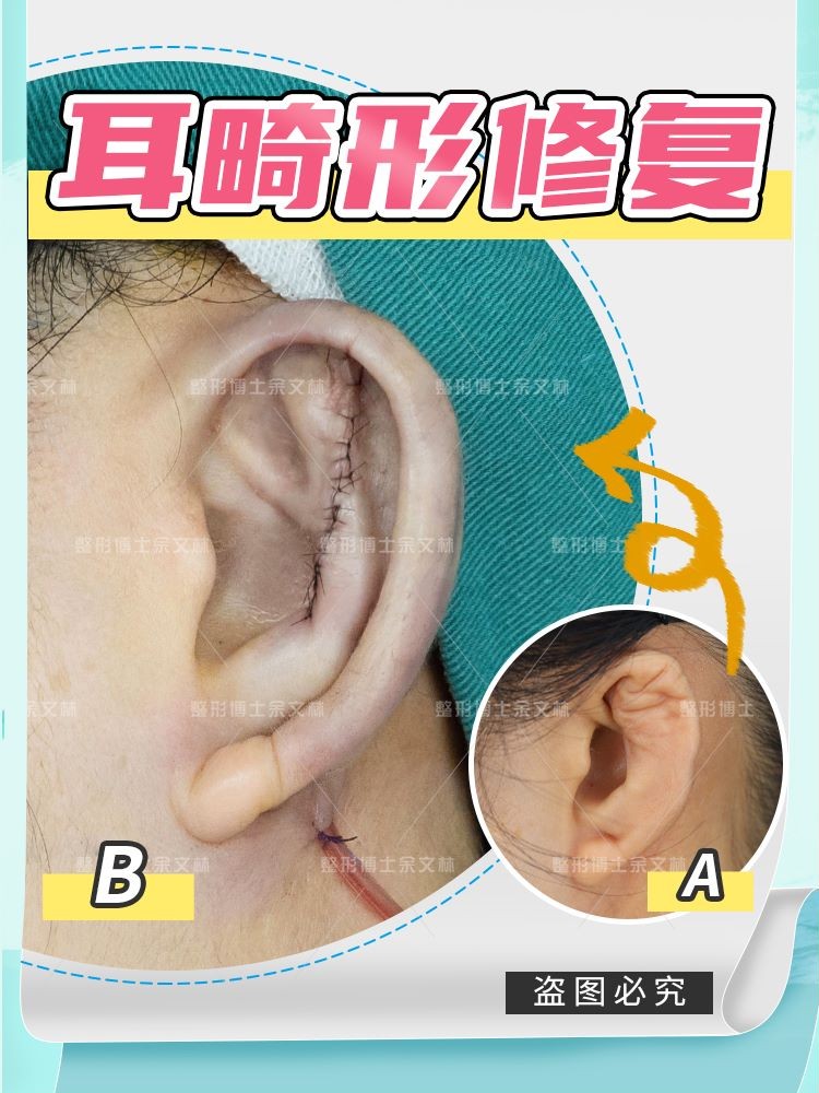 耳软骨隆鼻会塌下来吗,软骨隆鼻鼻小柱会塌吗