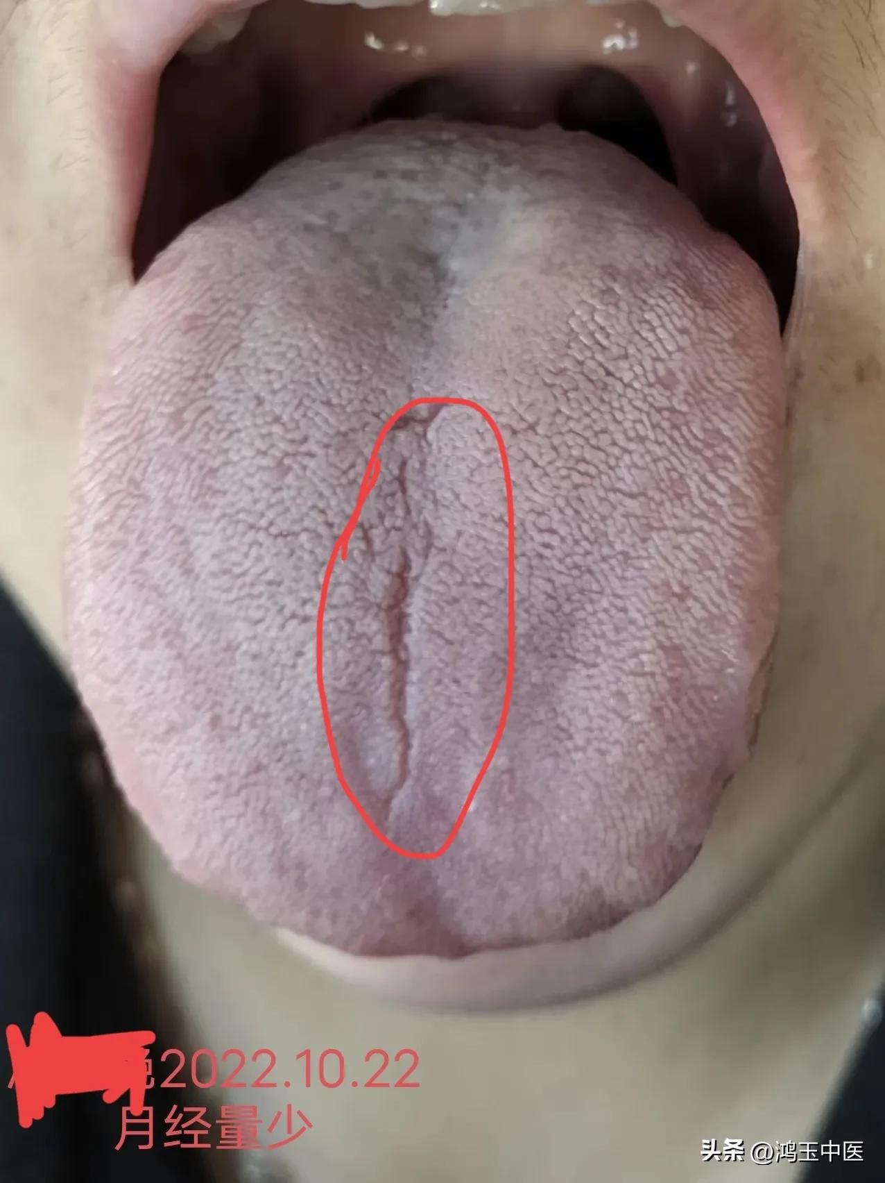 女性裂纹舌是什么原因引起的,裂纹舌影响生孩子么