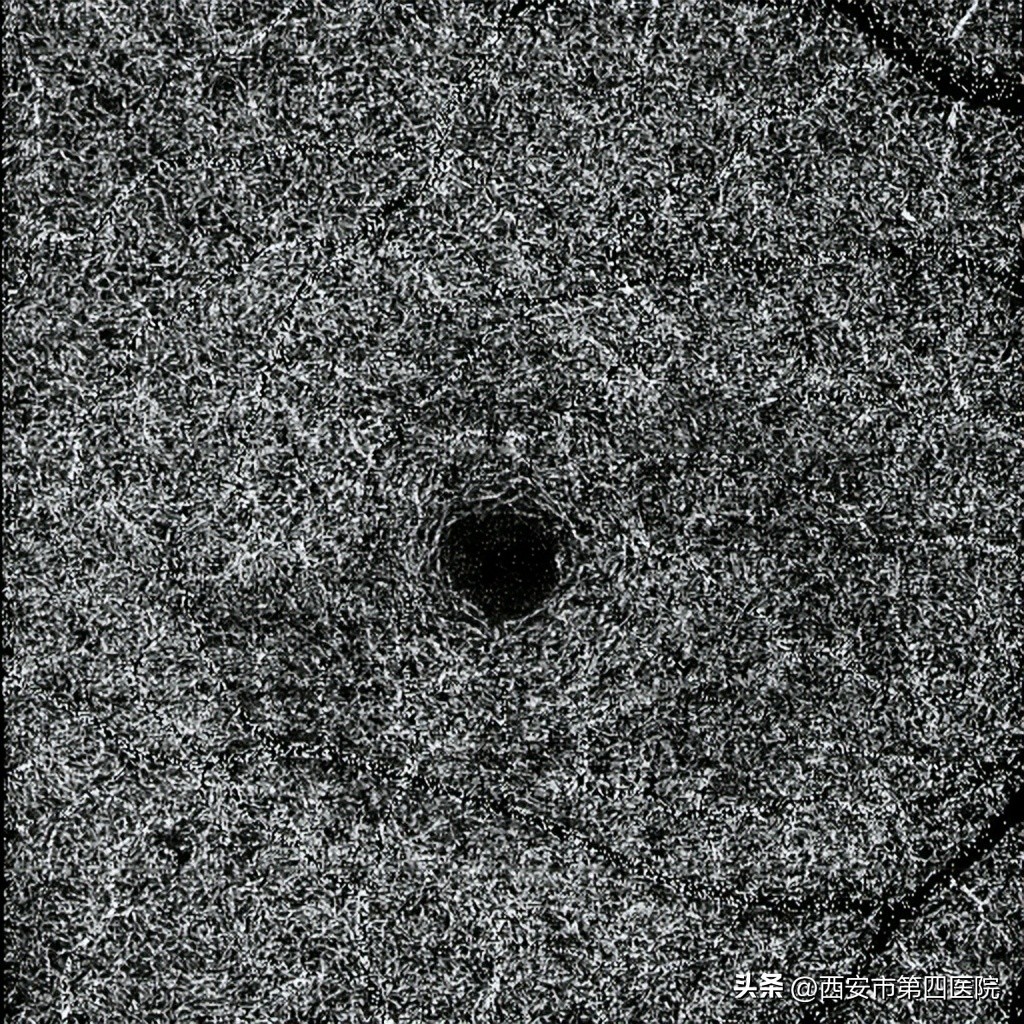 #新冠防疫手册#33岁女士“阳康”后视力下降、模糊、黑影……