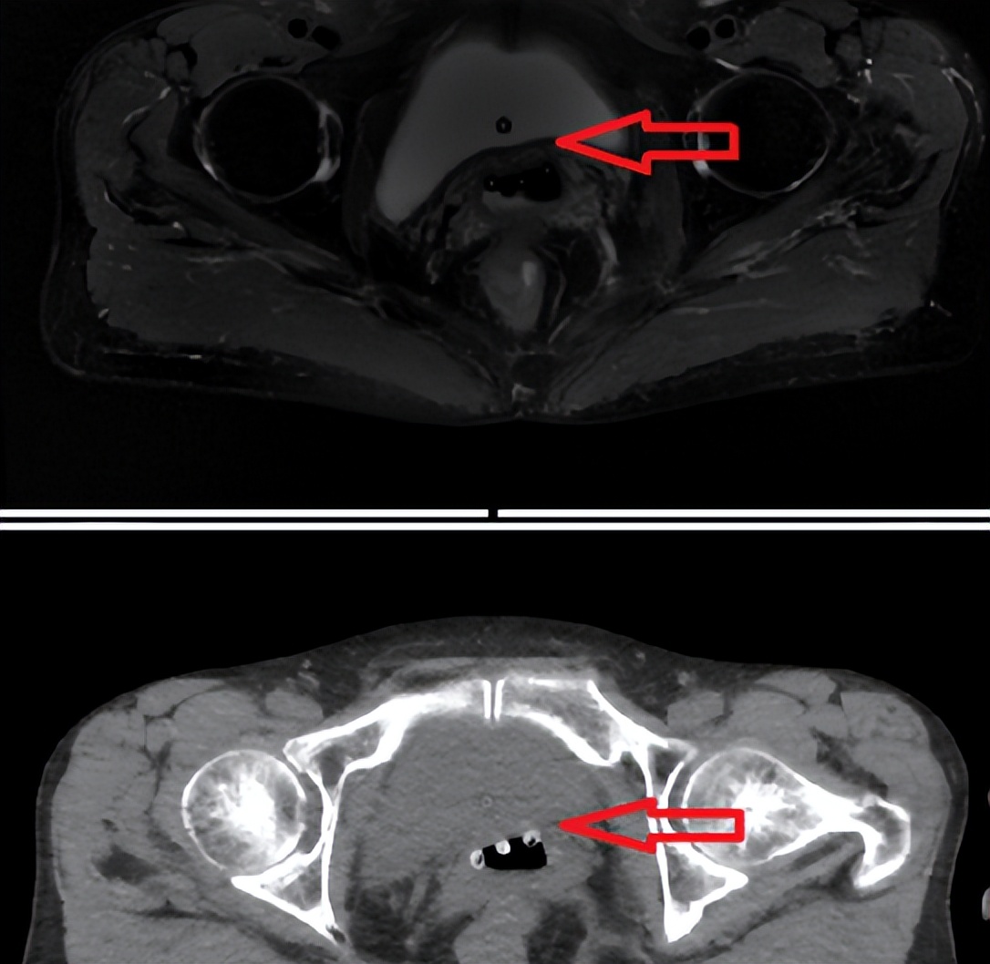 petct对各类肿瘤诊断的准确率,已确诊宫颈癌还有必要做petct吗