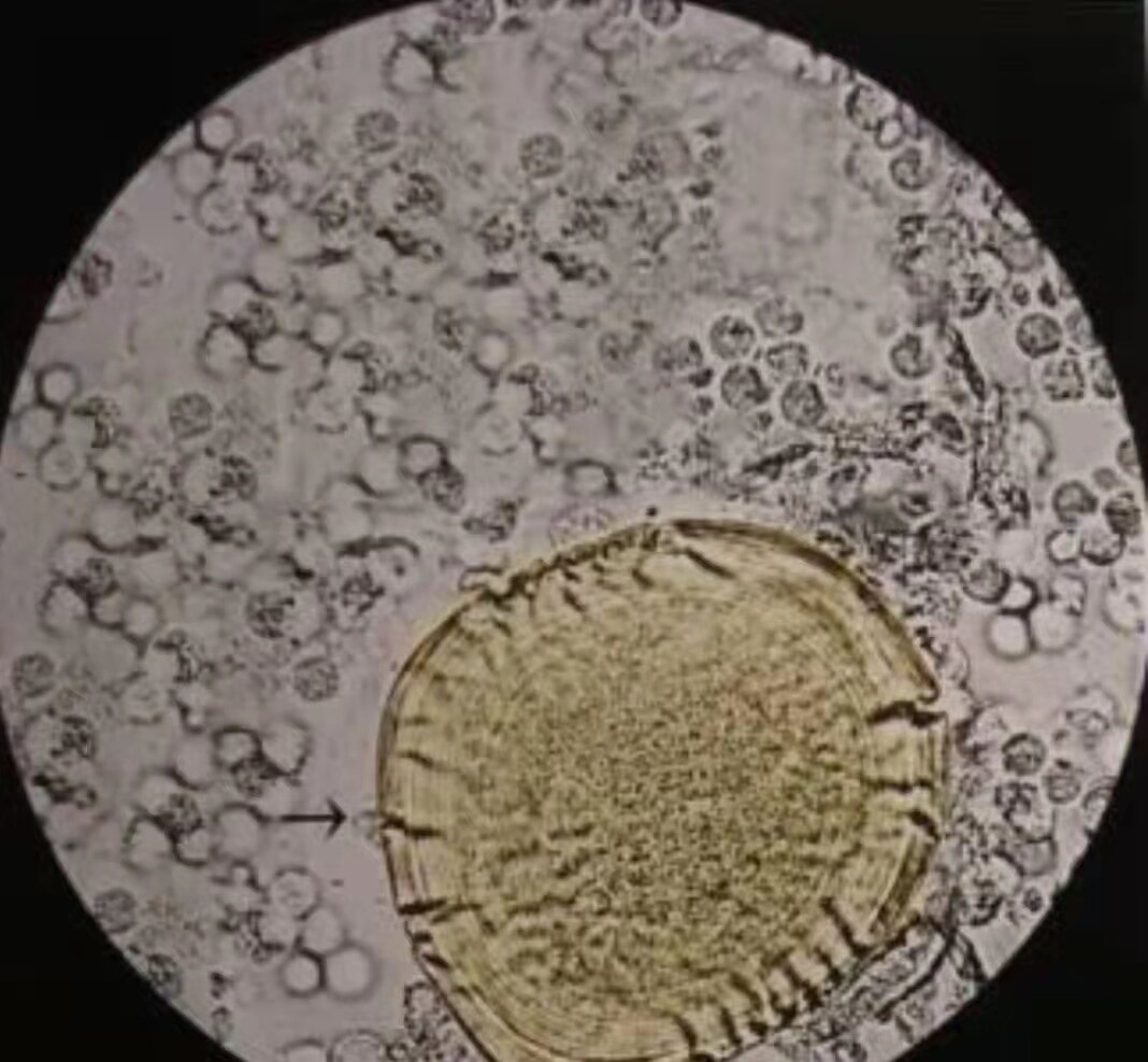 前列腺常规检查报告单正常,前列腺核磁共振报告单怎么解读