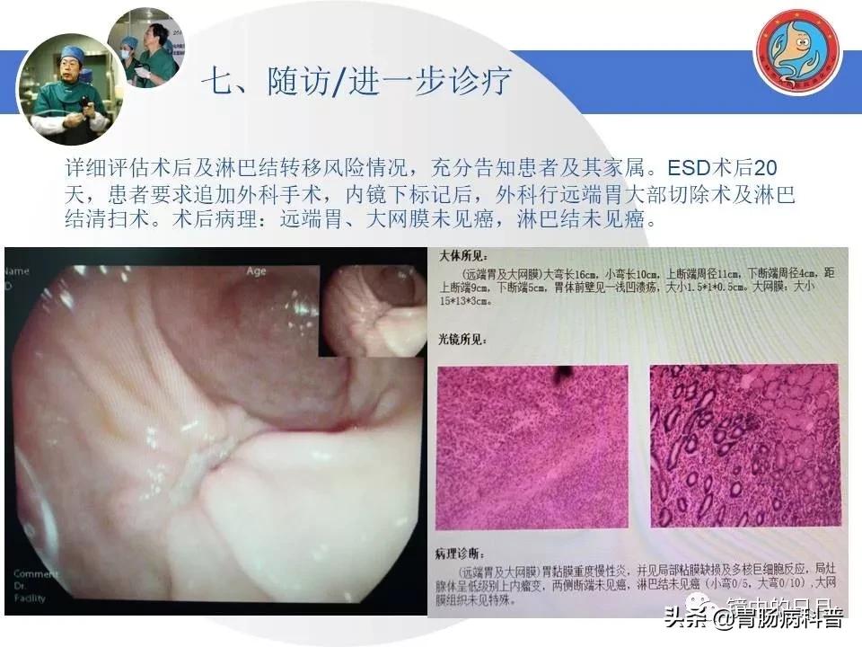 胃癌可以做内镜手术吗,早期胃癌内镜手术后追加外科手术