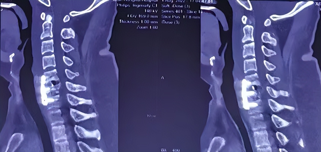 120紧急救援落石砸伤男子,紧急救援男人被电梯压死