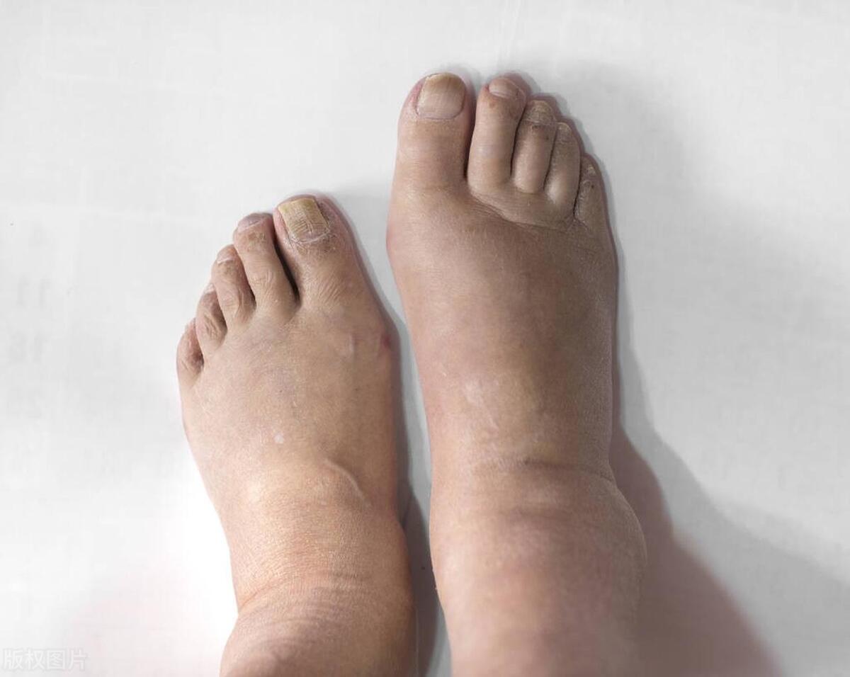 慢阻肺脚肿到膝盖,慢阻肺出现脚肿