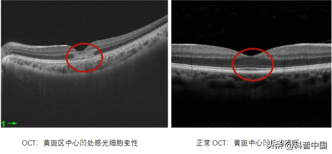 突然失明几秒钟是什么原因,眼睛莫名一只短暂失明原因