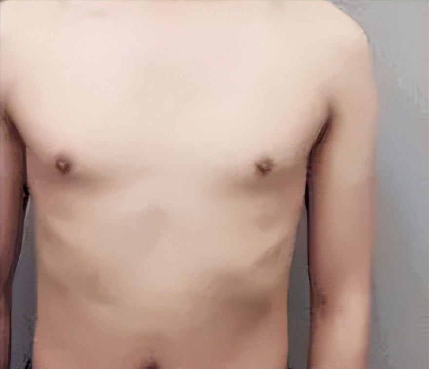 为什么男生的胸部很大,男生胸部大怎么办
