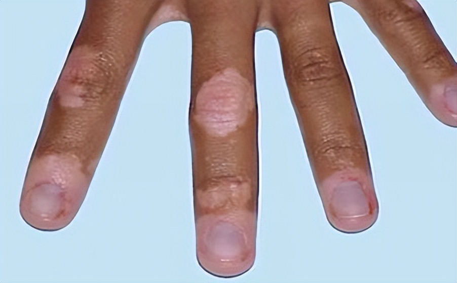 白癜风最需要补充什么,白癜风恢复得缓慢该怎么办