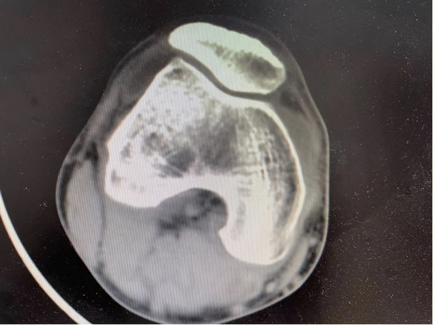 膝关节疼痛：膝关节积液的中医诊治