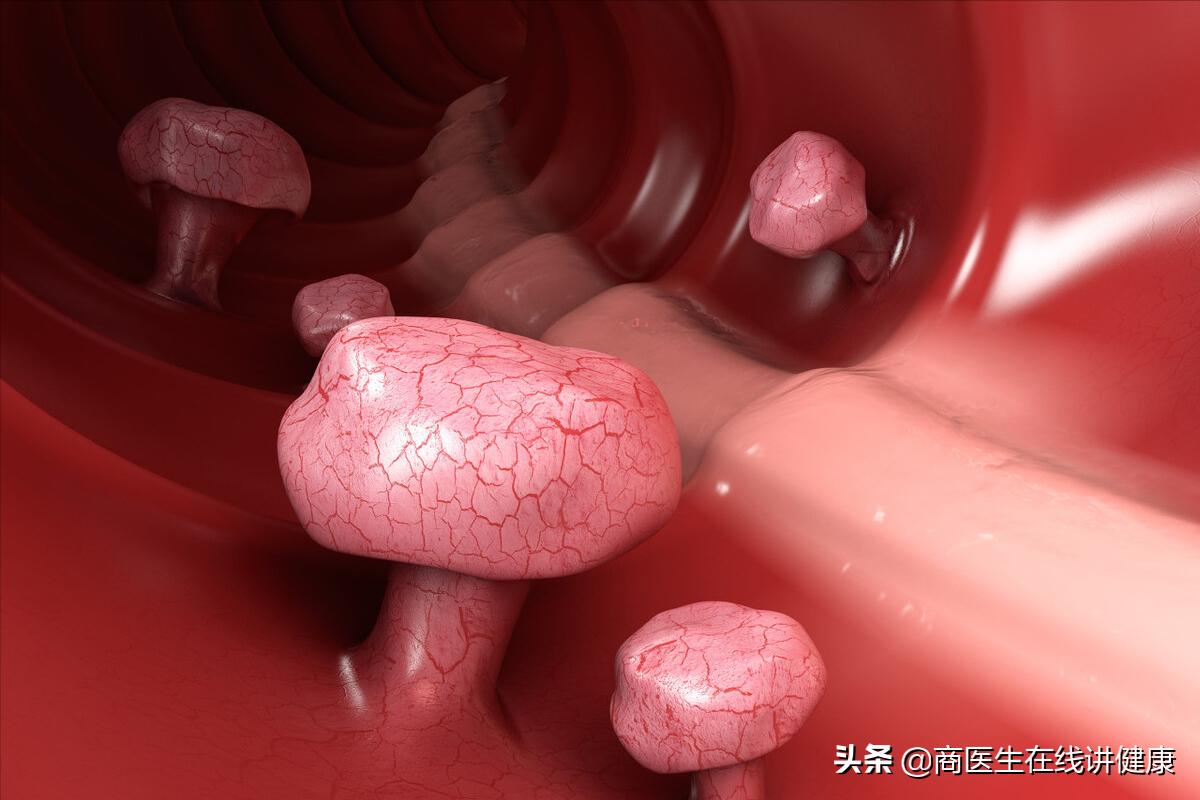 为什么肠道老是长息肉,为什么会有肠道息肉