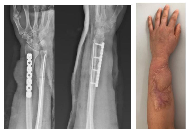 治疗骨折新技术,微创手术治疗骨折的方法