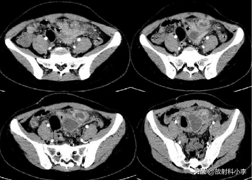 妇科急腹症的ct表现,妇科急腹症的诊断与治疗