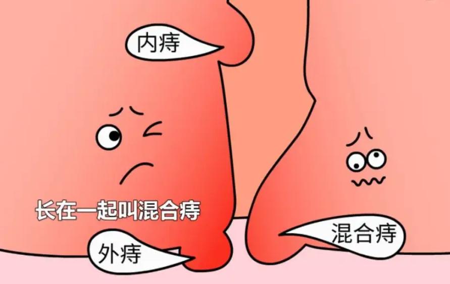 做痔疮手术换药全部流程,痔疮手术的真实经历第14天