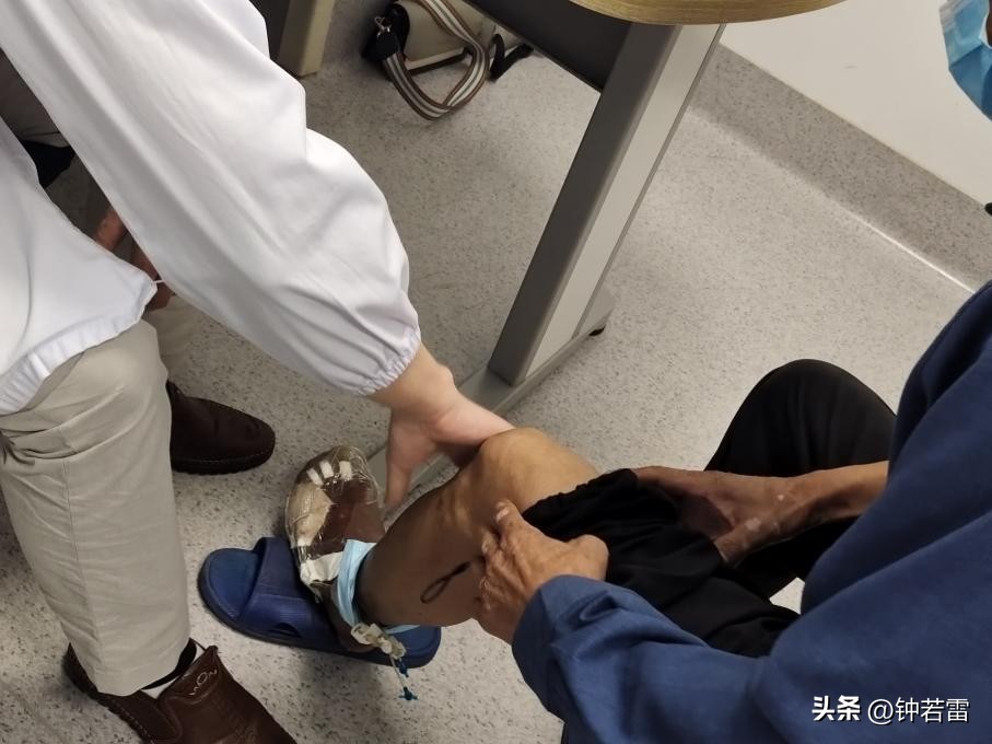 一年干掉300多斤酒？静脉曲张刘爹爹的脚趾“保卫战”