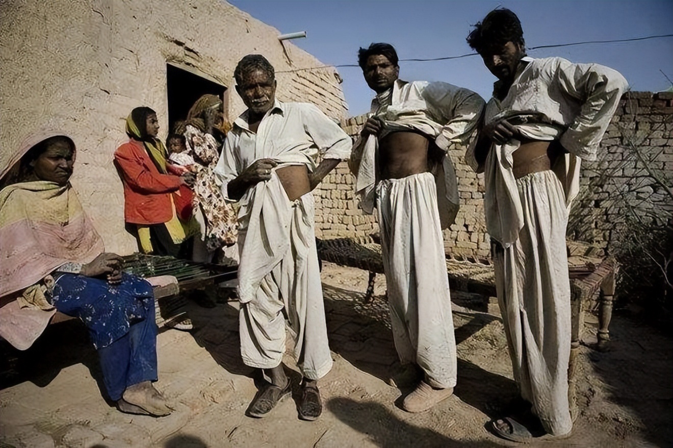 尼泊尔的单肾村,尼泊尔单肾村