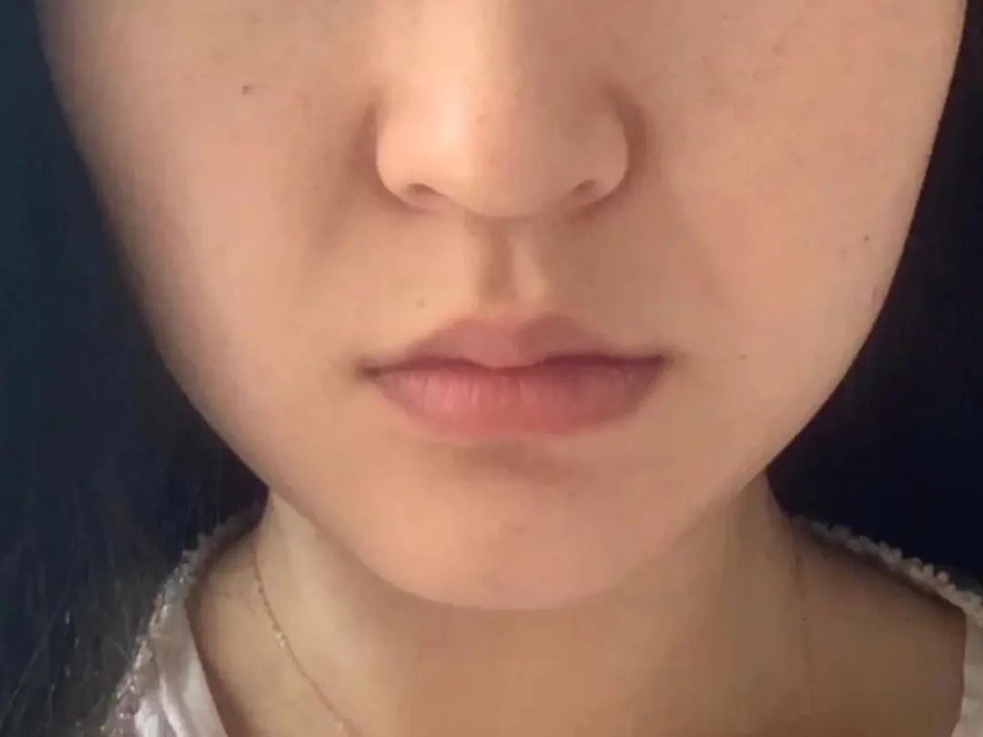 法令纹到底该怎么去除,如何正确的消除法令纹