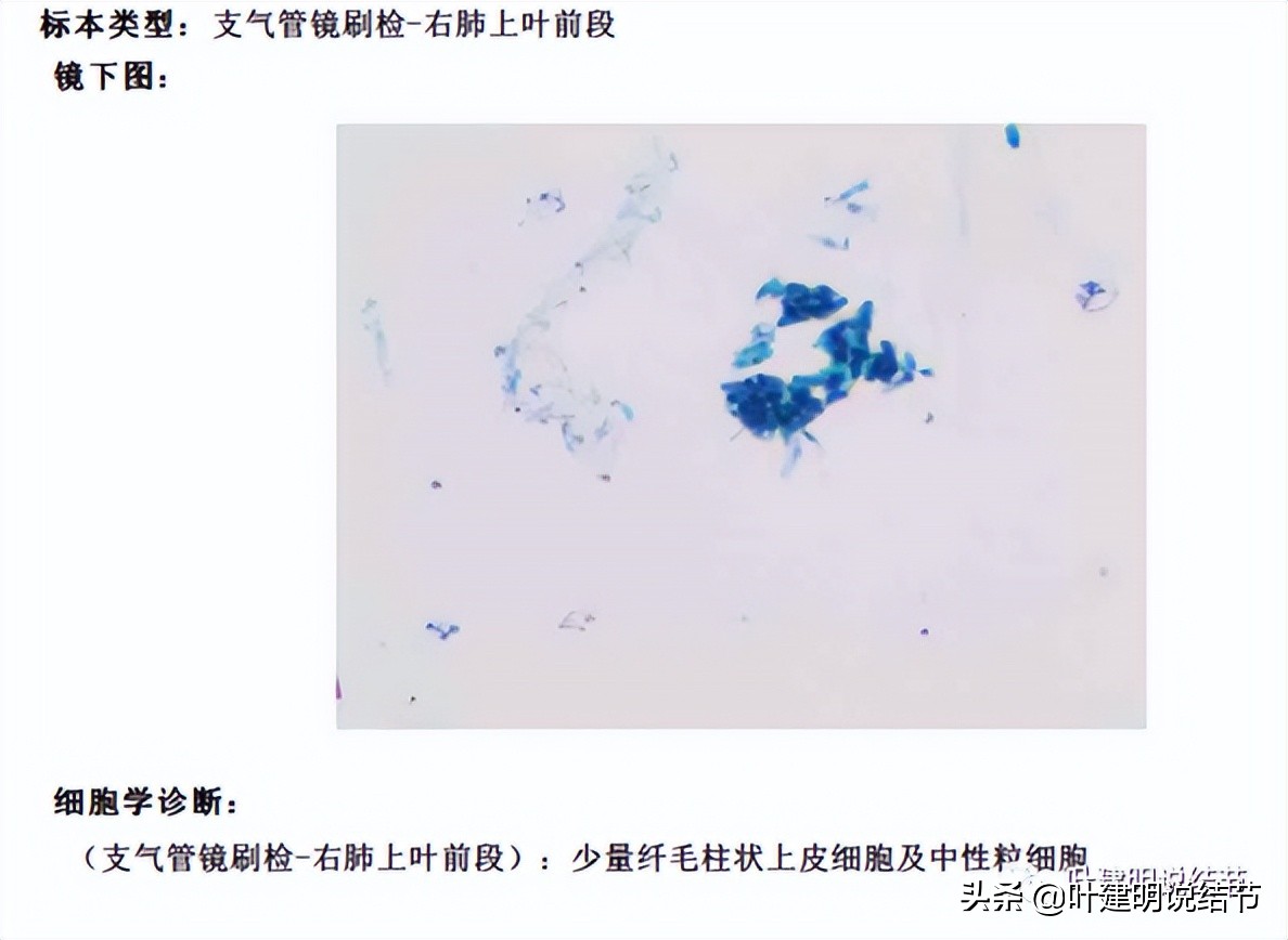 经验：肺占位超6厘米，不是癌还会是什么？临床上仍得多个心眼