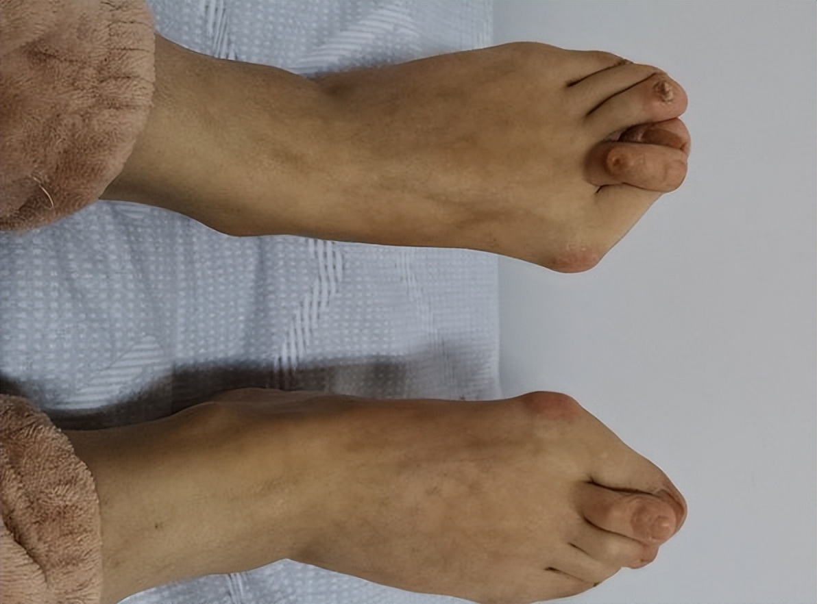 大脚骨拇指外翻后期会有什么后果,大脚骨拇外翻有什么影响