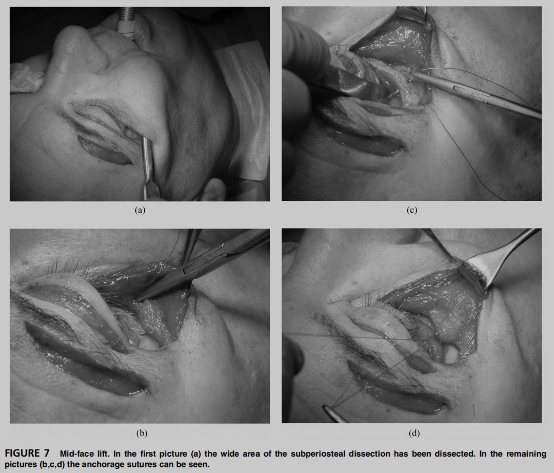 印第安纹解剖学,印第安纹分型对策