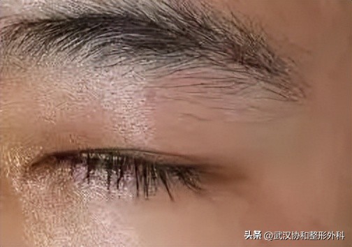 眼睑下垂术后会永久不闭合吗,上睑下垂术后睑裂闭合不全