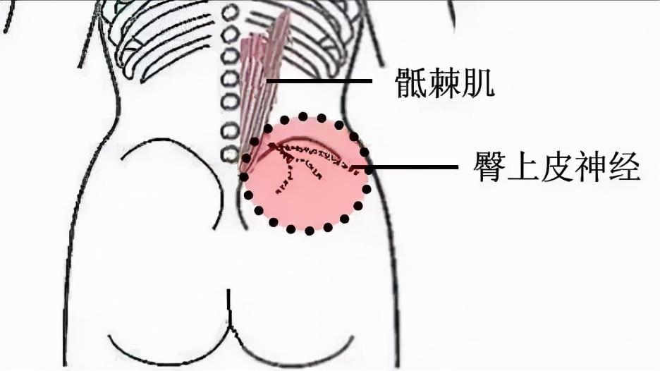真正好的腰椎间盘突出治疗方法,腰椎间盘突出不做有效治疗的后果
