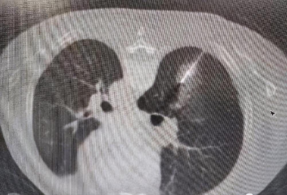 经皮肺活检术,经皮环肺静脉射频消融术名词解释