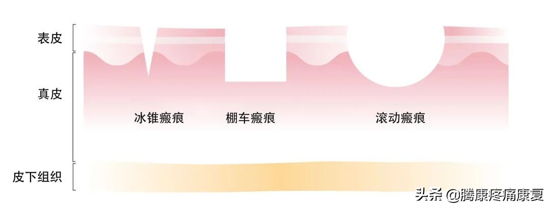 疮疗的后遗症怎么治疗,痤疮留下的瘢痕疙瘩