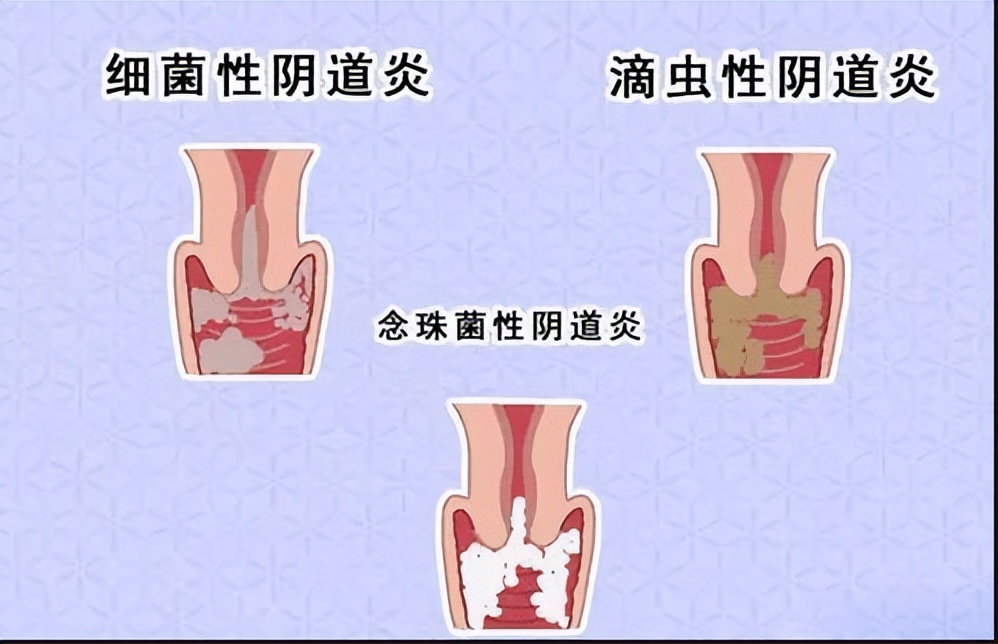 内裤一直是黄的是有妇科炎症了吗,内裤总是潮乎乎的是什么妇科病