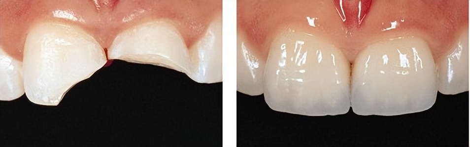 牙齿缺了一小块怎么办需要做牙冠,牙齿缺了一个角碰冷水会痛怎么办