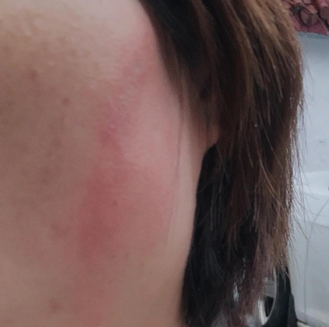 隐翅虫咬了后怎么处理,被隐翅虫咬了怎么办最快最有效