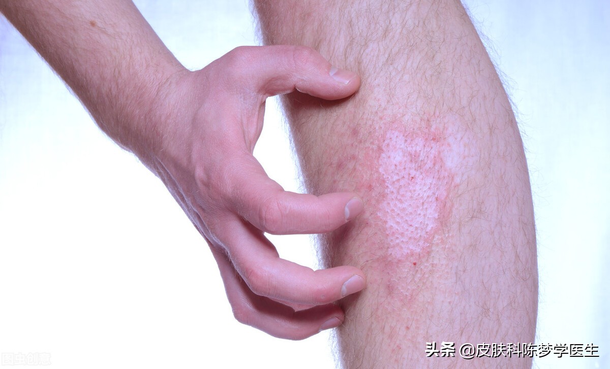 脸上红斑痒起皮屑是红斑狼疮吗,脸上有银屑病红斑怎么办